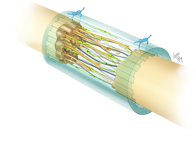 Nerve Repair Market